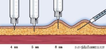 胰岛素注射4mm针头进针角度,胰岛素皮下注射1毫升操作