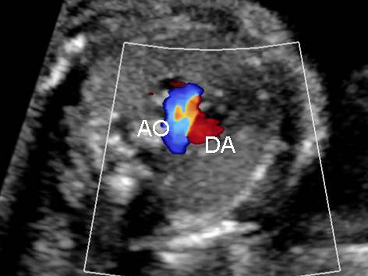 明明白白做超声26-4：胎儿心脏解剖结构异常-心室发育异常