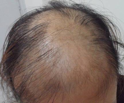 头顶后脑勺大面积脱发还能植发吗,男士大面积植发7个月