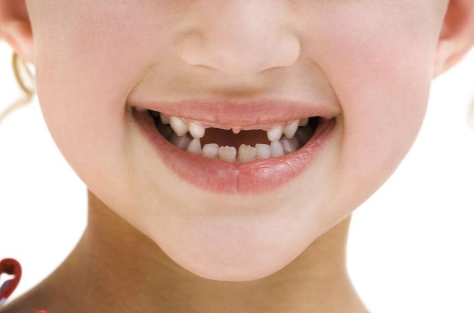 儿童牙齿如何保护防止蛀牙,预防小孩牙齿蛀牙最好做保护方法