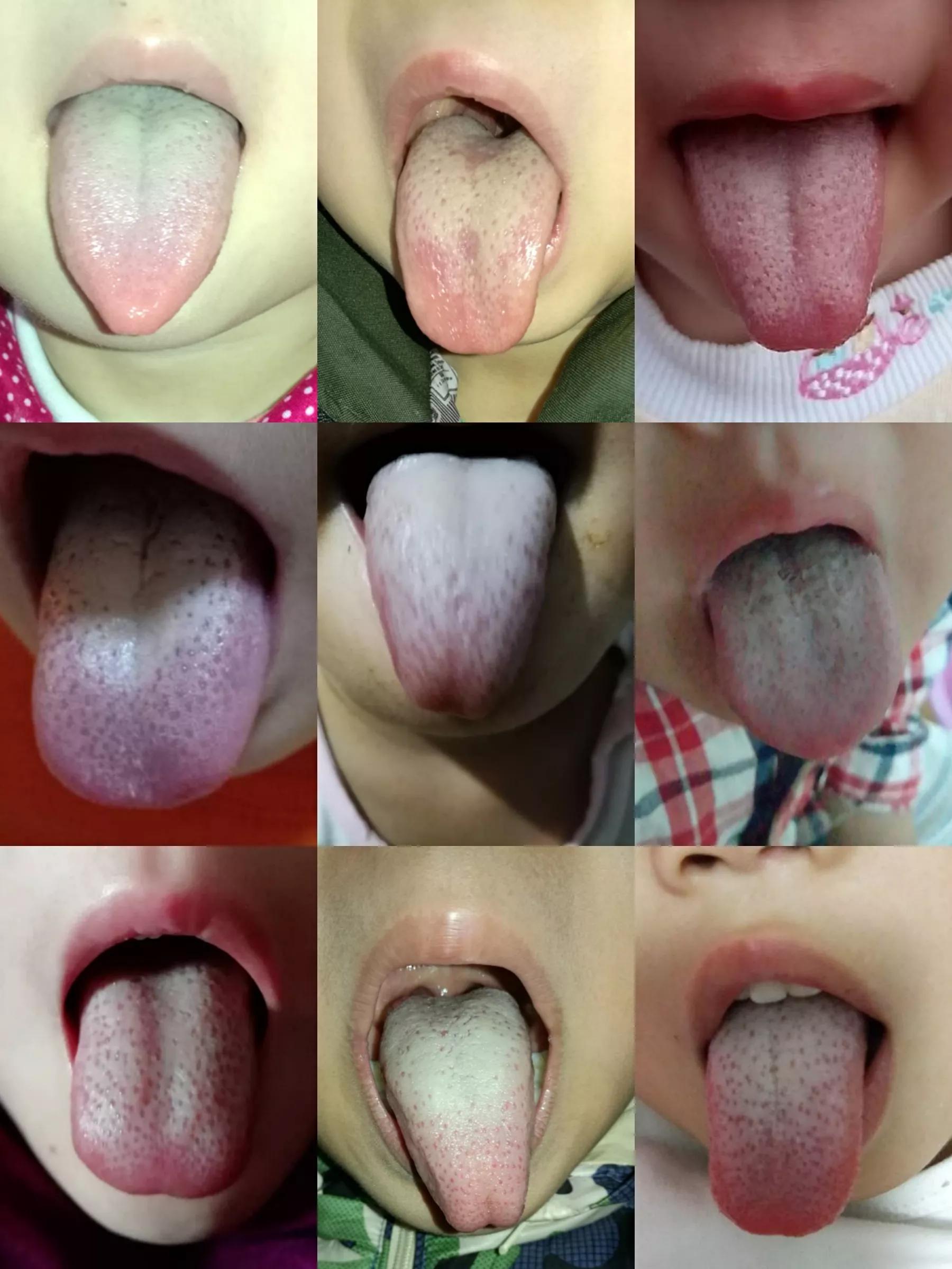 小儿积食按摩,关于小儿积食