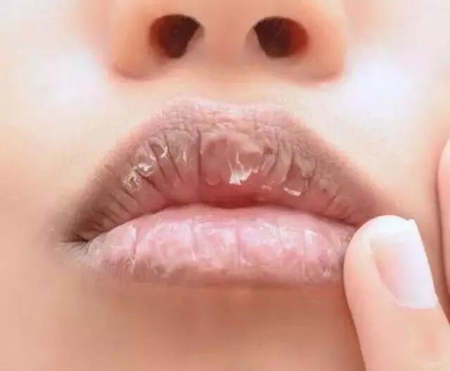 嘴上有死皮嘴唇干燥怎么涂口红,坐月子嘴唇干燥死皮怎么办