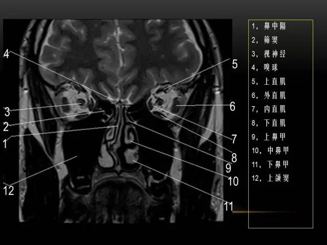 鼻腔鼻窦及颅底ct影像解剖,鼻窦解剖mri