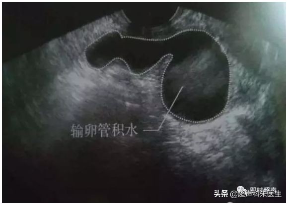 妇科超声的标准超声图,妇科超声图解