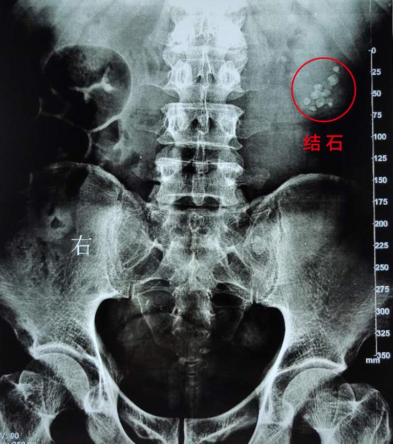 结石体质的人该怎么调理身体,结石体质是天生的还是后天养成的