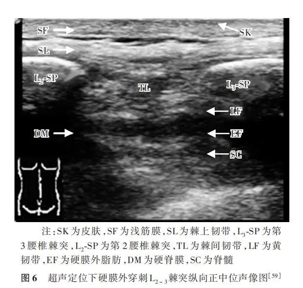 连续硬膜外阻滞术,星状神经节阻滞疗法中国专家共识