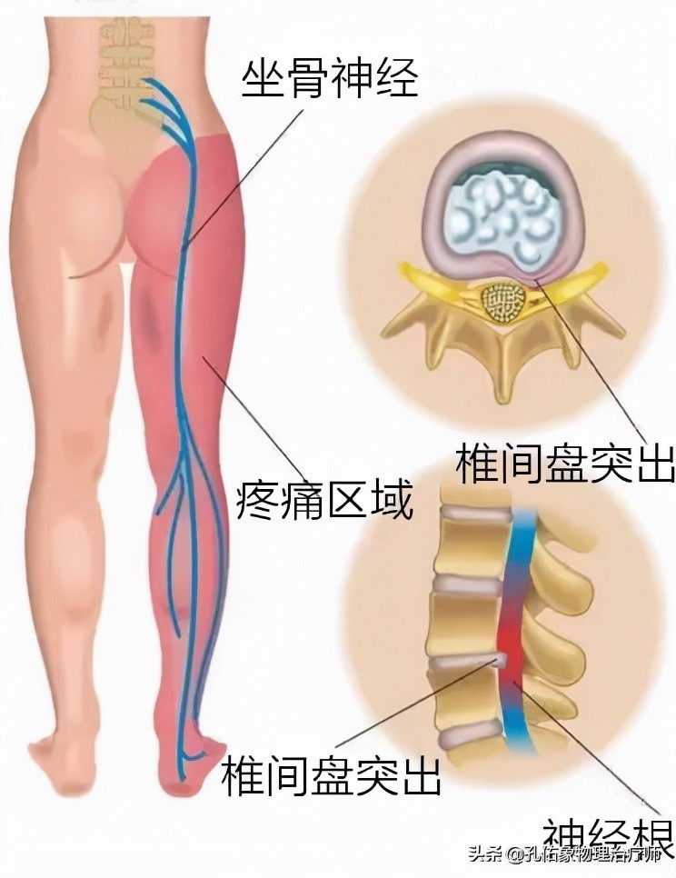 有腰间盘突出症右屁股疼怎么回事,腰骶疼痛是腰椎间盘突出引起的吗