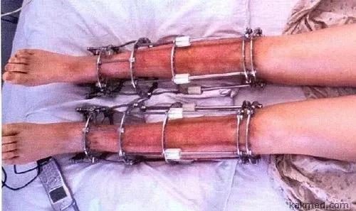 女子要做断骨增高手术,中国首例断骨增高术