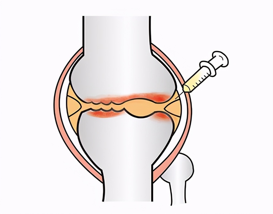 日本足协与再生法人机构签订再生医疗支援协议，修复球员运动损伤