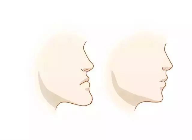 一分钟带你看牙齿矫正的全过程,最常见的牙齿矫正问题速度收藏