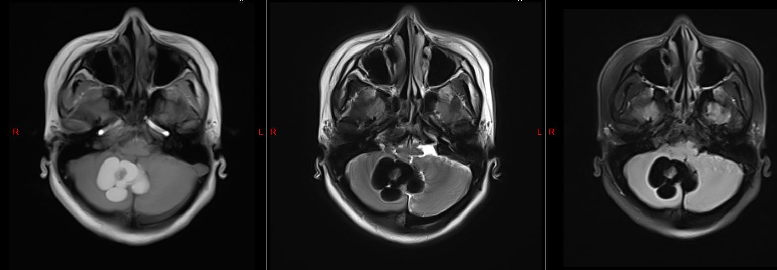 24岁脱发患者,24岁熬夜脱发