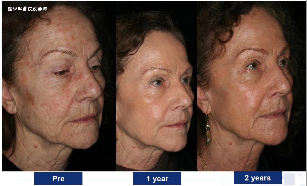 超脉冲co2点阵激光可以祛妊娠纹吗,脉冲点阵激光和co2点阵激光