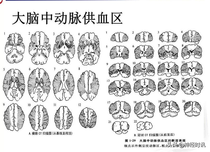 脑动脉解剖学讲解,基底节区脑血管解剖