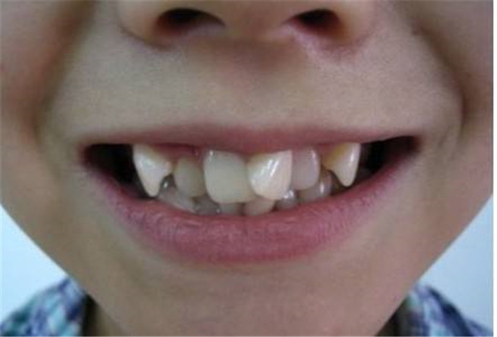 孩子坏牙掉了牙根还在,孩子坏牙换牙能好吗