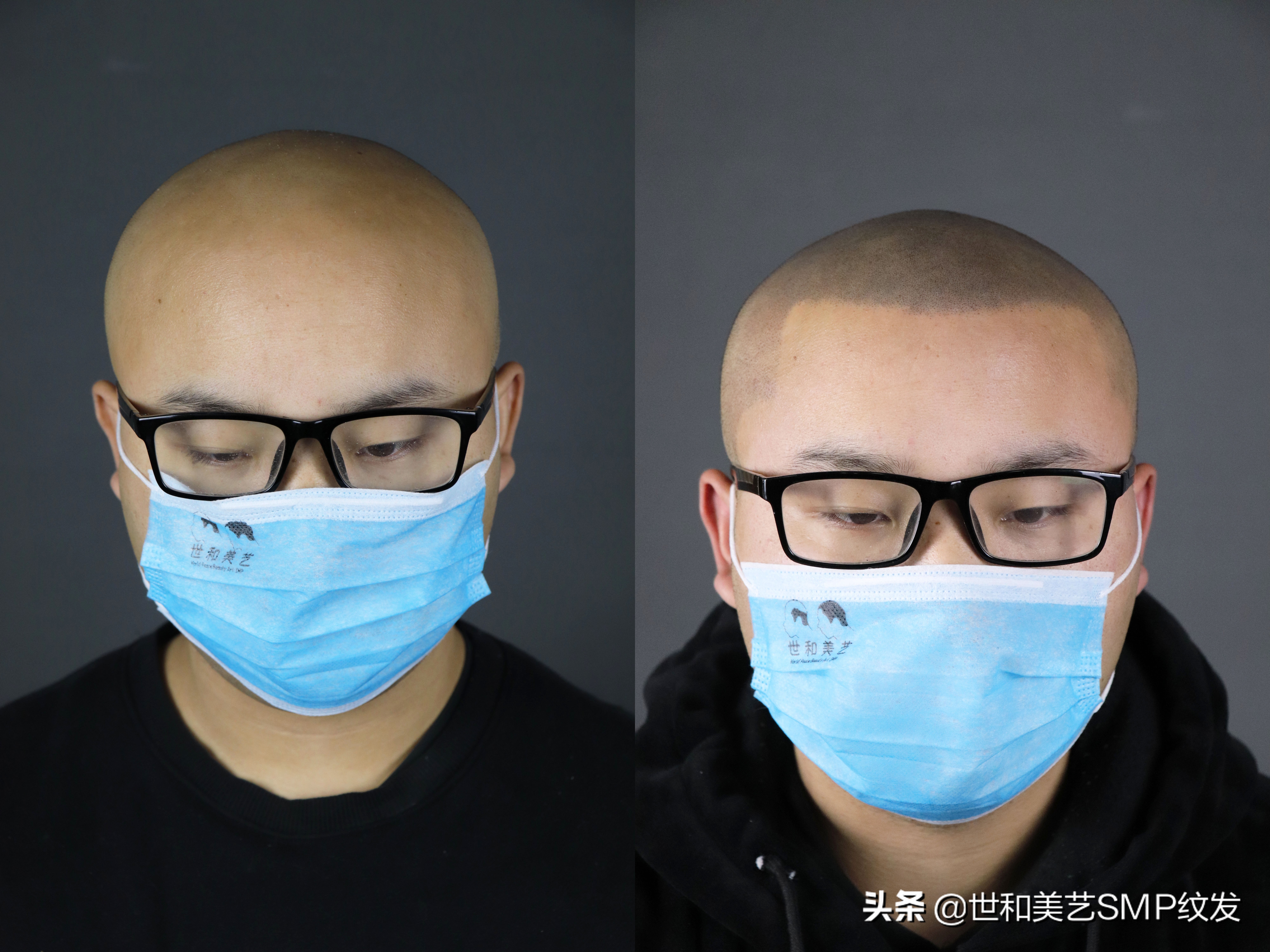 古代秃顶了怎么处理,古代秃顶的男人怎么办