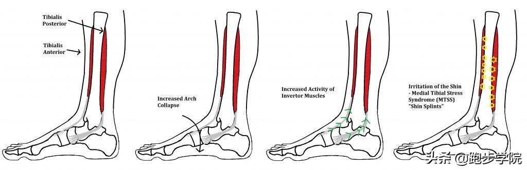 伤害了1/3跑者的胫骨炎，请务必重视起来