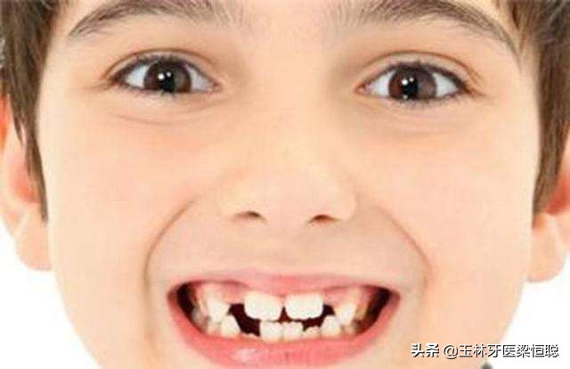 儿童门牙锯齿状多长时间会磨平,孩子的门牙长得像锯齿一样怎么办