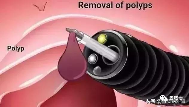 广基型胃息肉3mm会直接癌变吗,一年前查出胃息肉一年后会癌变吗
