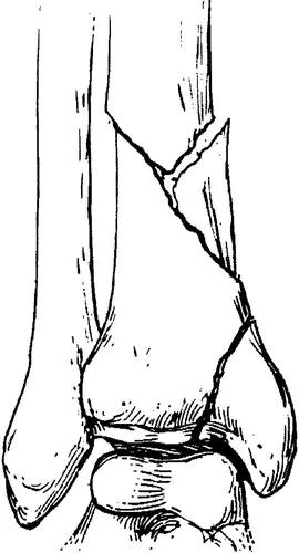 所有骨折都叫什么名字,骨折的名称有哪些