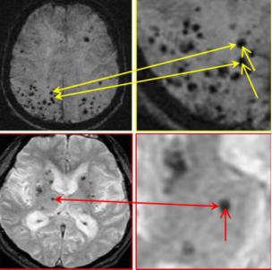 脑微出血怎么治疗,脑卒中隐形杀手