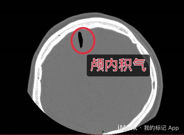 脑子进风了头疼怎么办,脑子进气会如何