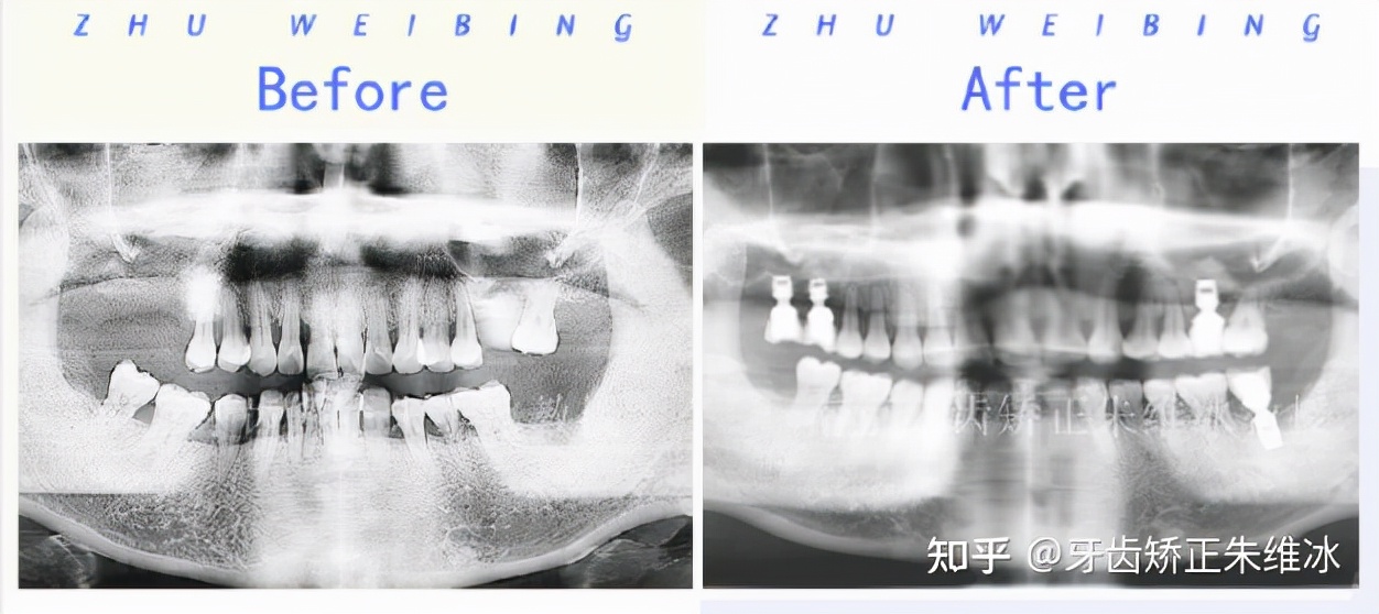 南京牙齿矫正龅牙前突要多少钱,36岁牙周不好龅牙能整吗