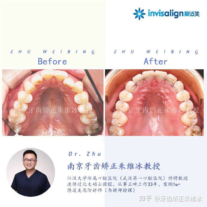 南京牙齿矫正骨性嘴凸案例,郑州牙齿矫正会让脸型更好看吗