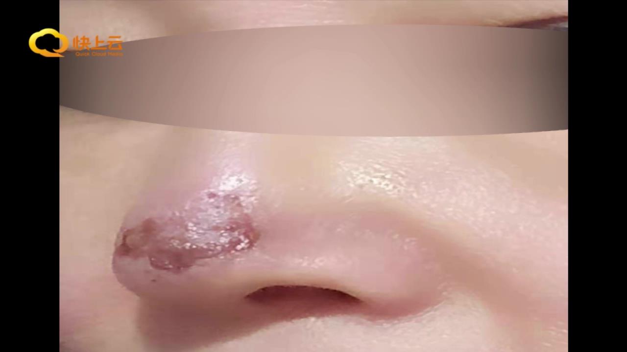 参加医美活动鼻部填充玻尿酸出现问题要说法博雅美容整形：没责任 法律途径解决