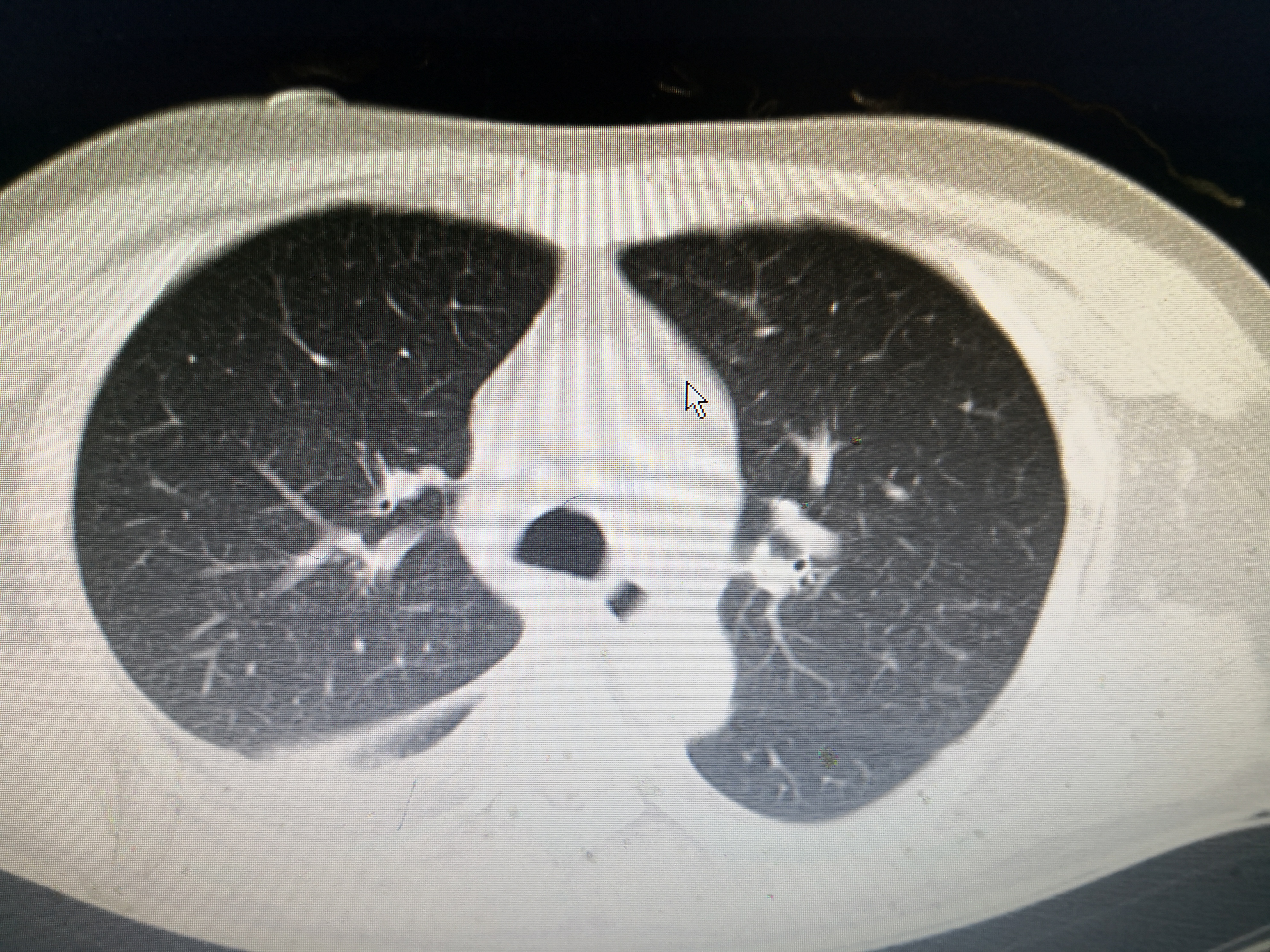 重症肺炎的急救配合要点,重症肺炎针对性护理措施