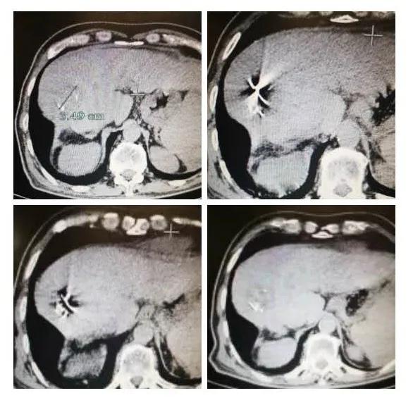 介入治疗肝癌能杀死癌细胞吗,介入治疗能把癌细胞饿死吗