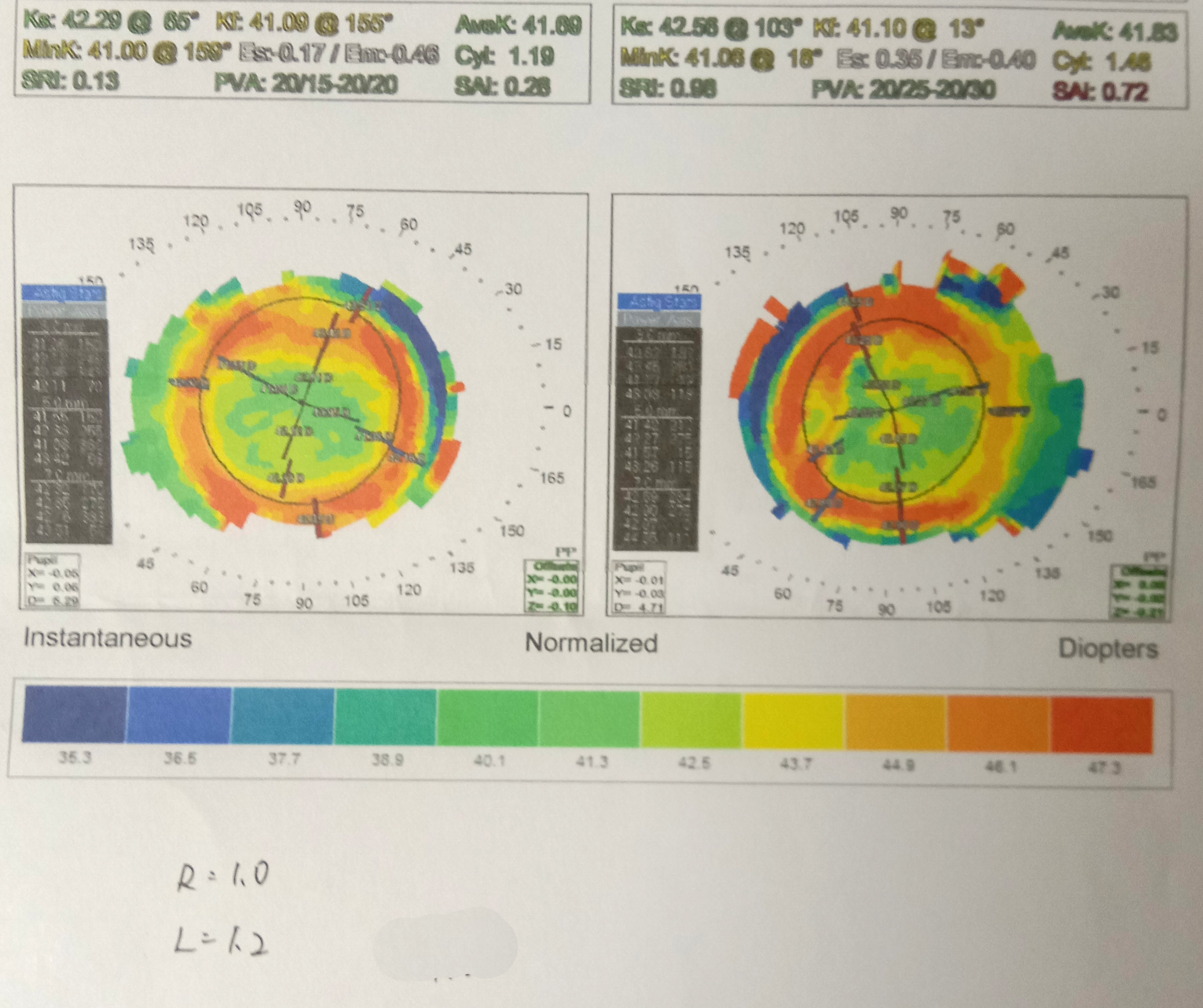 一个近视孩子妈妈的心路历程---角膜塑形镜攻略