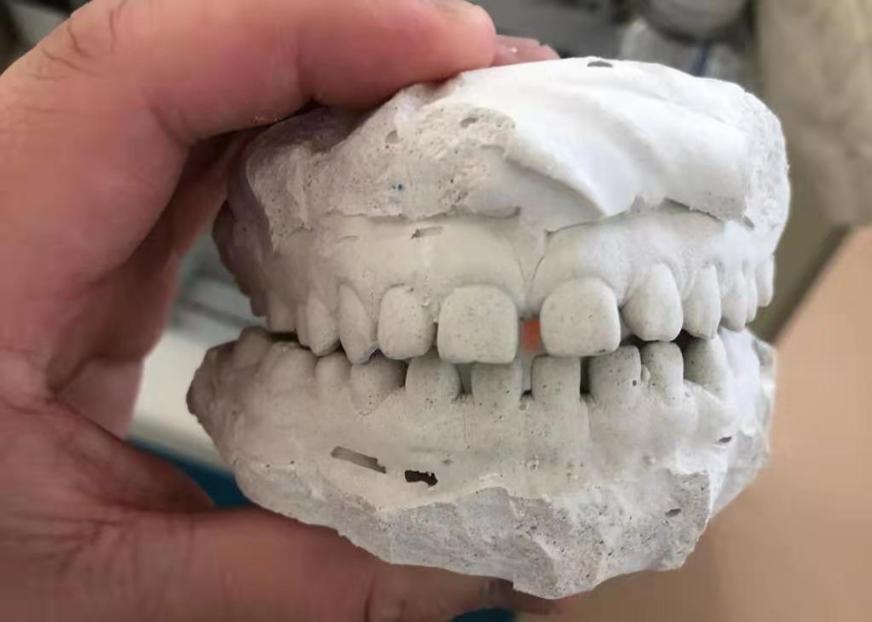 牙缝变大咬东西酸软无力,牙缝变大不舒服