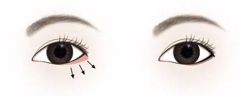 石原里美的眼睛有整容吗,石原里美双眼皮是什么型