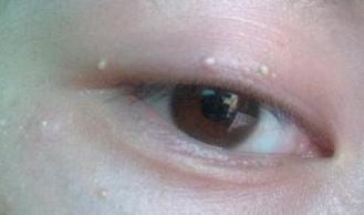 一颗脂肪粒会自己消失吗,可恶的脂肪粒