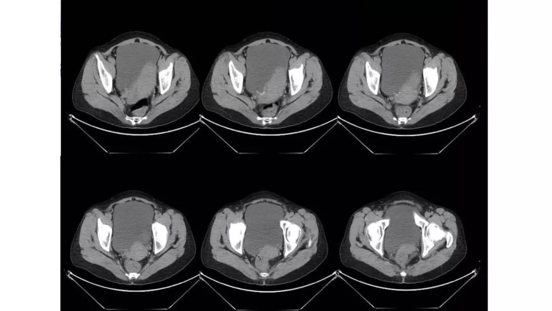 卵巢原发肿瘤的分析思路