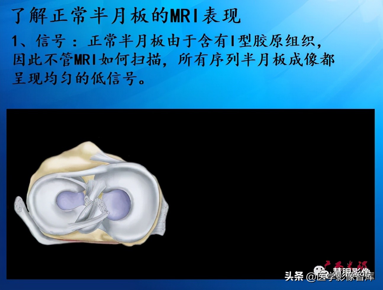 膝关节半月板损伤的解剖结构图,半月板mri解剖图解