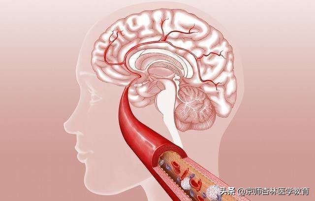 脑血栓形成的考试题,执业医师考试脑血管疾病视频