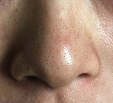 油皮去黑头最有效的方法,油皮黑头有效护肤教程