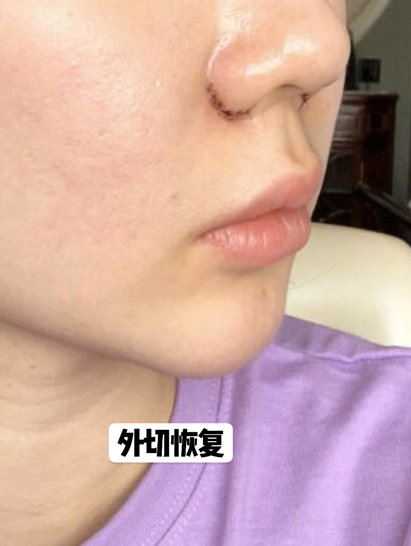 鼻翼缩小可以单独做吗,内切鼻翼缩小有效果吗