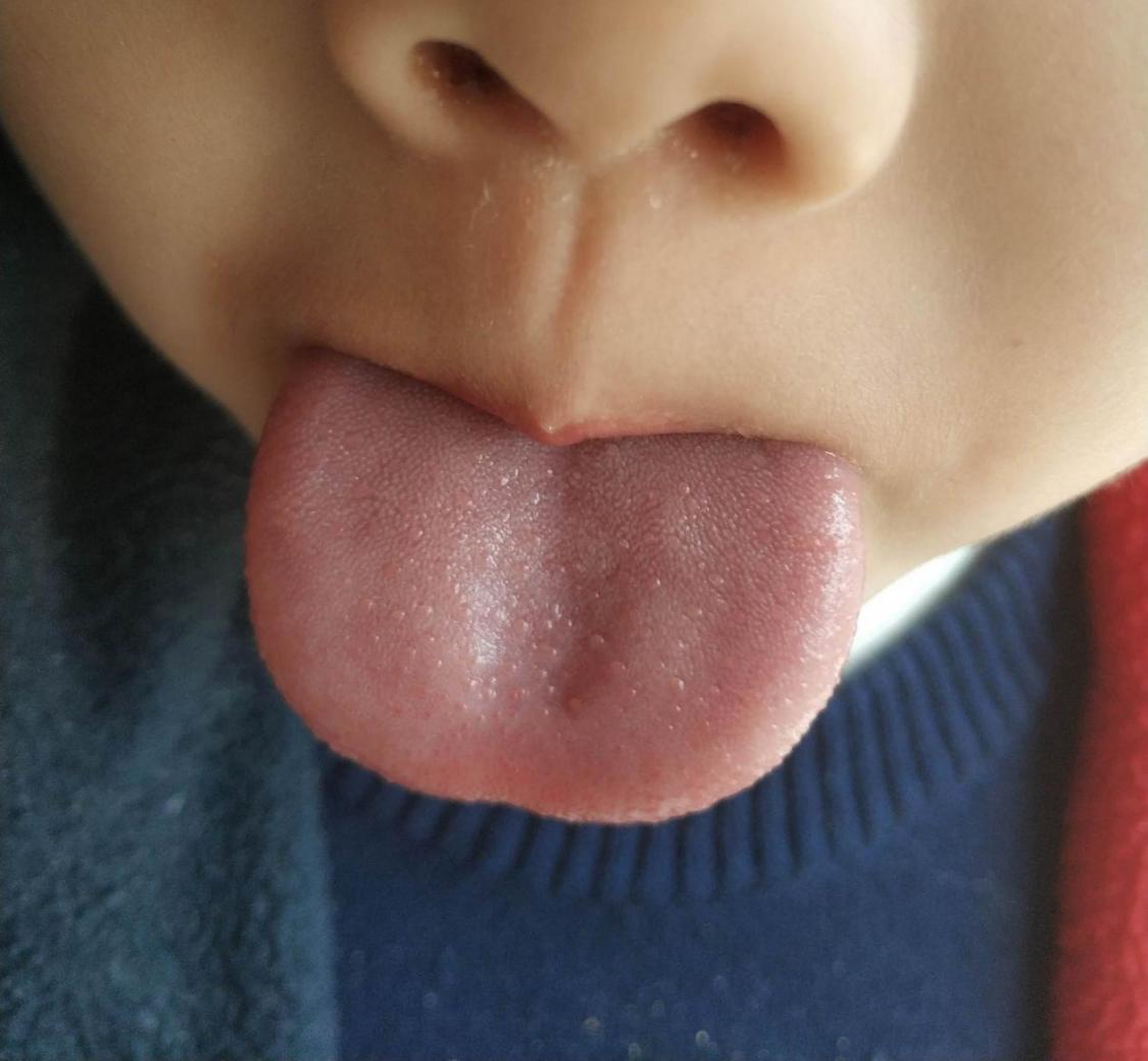 小孩没有咳嗽流鼻涕检查ct是肺炎,咳嗽流鼻涕检查什么