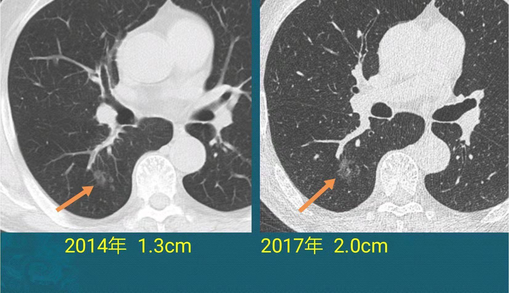 年纪大了得了肺癌怎么办,年纪轻轻得了肺癌怎么办