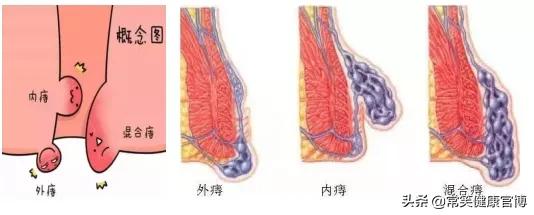做痔疮手术是不是直接把痔疮切除,痔疮手术前需要把痔疮留在外面吗