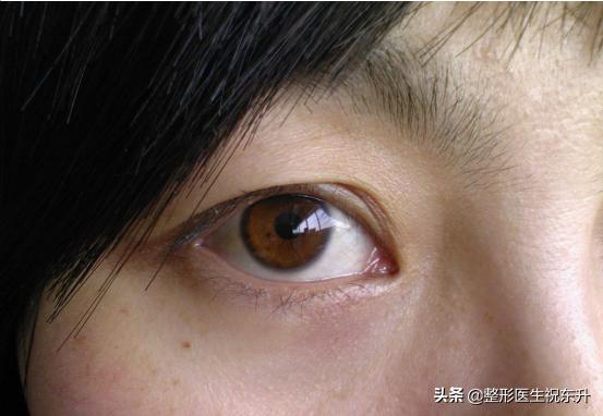 下眼皮松弛祛松皮后会回缩吗,上眼皮松弛下垂怎么办不用眼霜