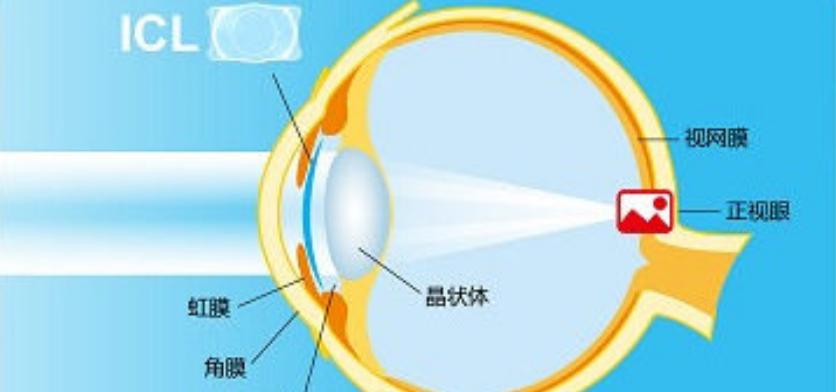 近视1000散光300能做激光手术么,1000度近视半飞秒手术亲身经历