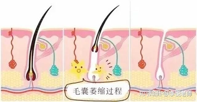 如何安全剔除毛发,如何永久除去身体体毛