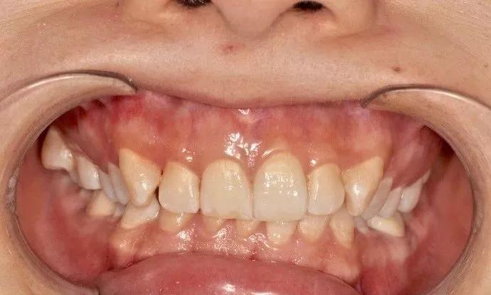 牙齿很整齐拔牙正畸前后效果,虎牙齿矫正的前几天有什么反应