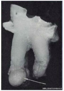 孩子牙只剩残根怎么换牙,只剩残根的牙真的能补救吗