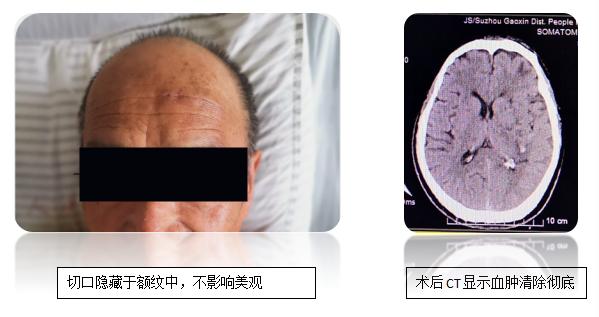 神经外科脑出血微创手术,微创神经介入治疗脑出血后遗症