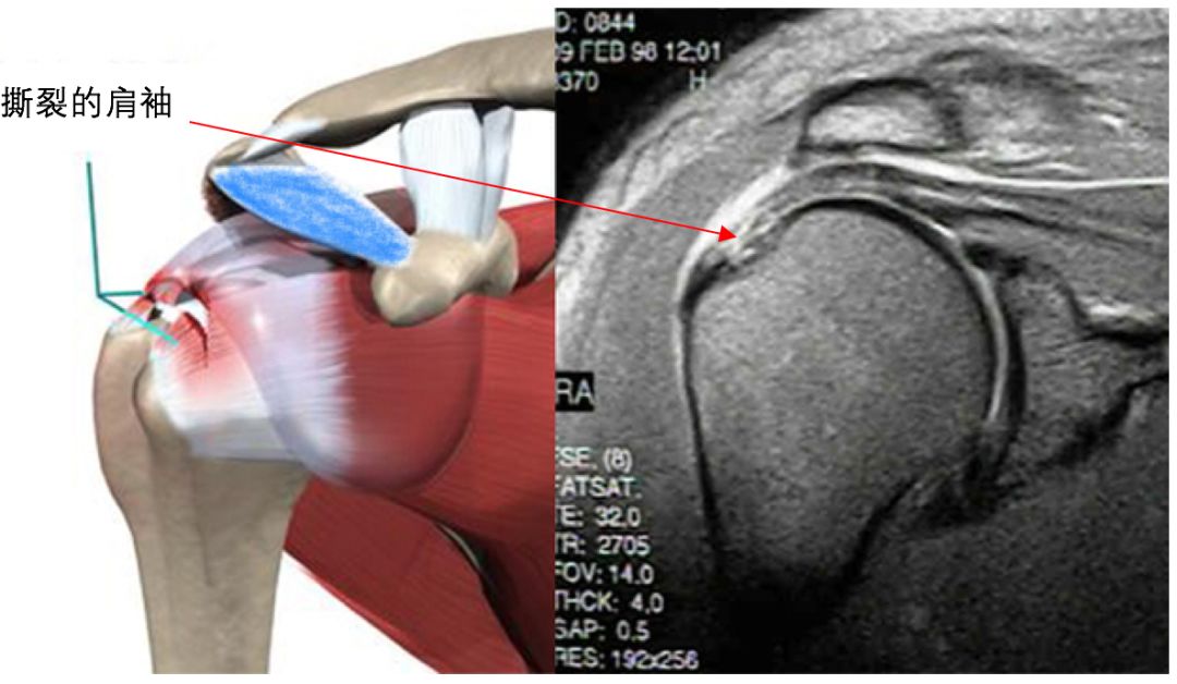 肩袖损伤和肩周炎粘连,肩袖损伤肩周炎冻结肩