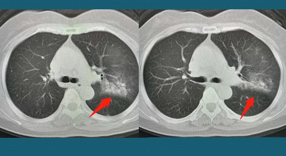 两名病情好转的心冠患者,轻度病毒性肺炎20天快好了